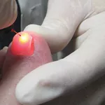 Лазерное лечение онихомикоза (грибка ногтей) в кабинете лазерной хирур