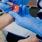 Tratament laser a onicomicozei (Infectia fungica a unghiei,  micoza 