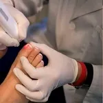   Corectie laser (Tratament laser) a unghiei incarnate in Chisinau