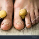 Лазерное лечение онихомикоза (грибок ногтей) в (Кишинев) Молдове!