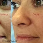 Лазерное удаление новообразований: родинок,  (невусов) бородавок папилл