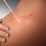 Лазерное удаление шрамов и рубцов (Лазерная коррекция дефектов кожи (рубцов/шрамов)) в Кишиневе,  Молдове!