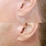 Tratament cu laser pentru indepartarea si  eliminarea,  (corectia) cicatricelor  in cabinetul de chirurgie laser “LaserMedChisinau” in Moldova!