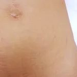 Лазерное удаление растяжек и стрий. Удаление растяжек лазером и стрий в Кишиневе!