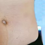 Tratamentul vergeturilor cu laser fractional in Moldova!