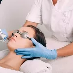 Лазерное удаление веснушек в Кишиневе!