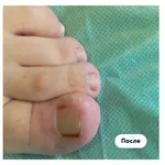   Corectie laser (Tratament laser) a unghiei incarnate in Chisinau,  Moldova!