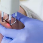 Blefaroplastie cu laser (Chirurgia laser estetica a pleoapelor) in (Ch