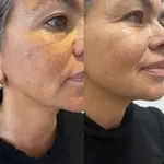     Подтяжка лица 