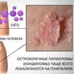  Лазерное удаление oстроконечных кондилом и генитальных бородавок в Кишиневе,  Молдове!