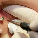 Tratament laser pentru vegetatiile veneriene (condiloamele, condyloma acuminata, negii genitali, condiloamele perianale, veruci genitale) in Chisinau, Moldova!