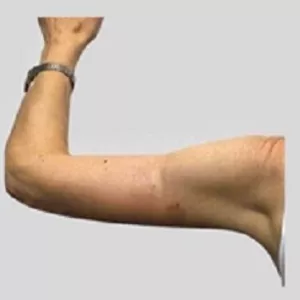Brahioplastie - aspect tonifiat și proporțional al brațelor