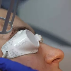 Rejuvenare cu  laser a pleoapelor in Moldova (Chisinau)!