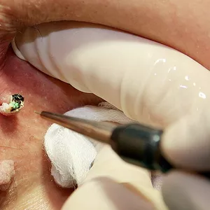 Tratament laser pentru vegetatiile veneriene (condiloamele,  condyloma acuminata,  negii genitali,  condiloamele perianale,  veruci genitale) in Chisinau,  Moldova!