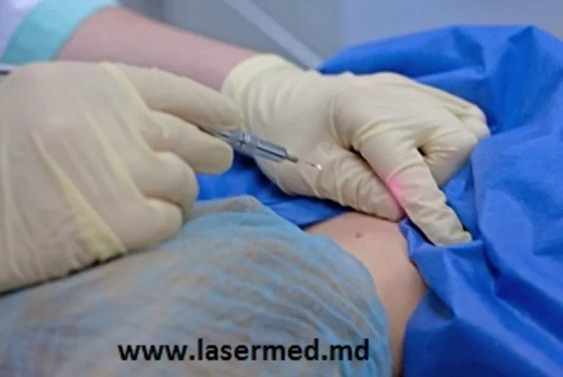 Удаление родинок лазером в кабинете лазерной хирургии ”LaserMedChisina 2