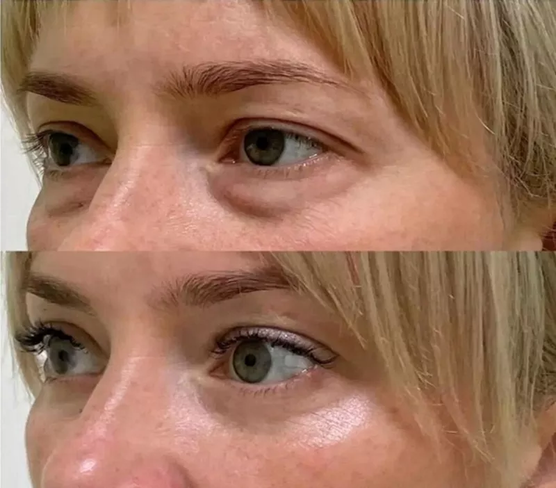 Blefaroplastie inferioară – înlătură pungile de sub ochi