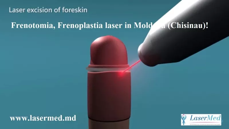 Frenotomia,  Frenoplastia laser in Moldova (Chisinau)!