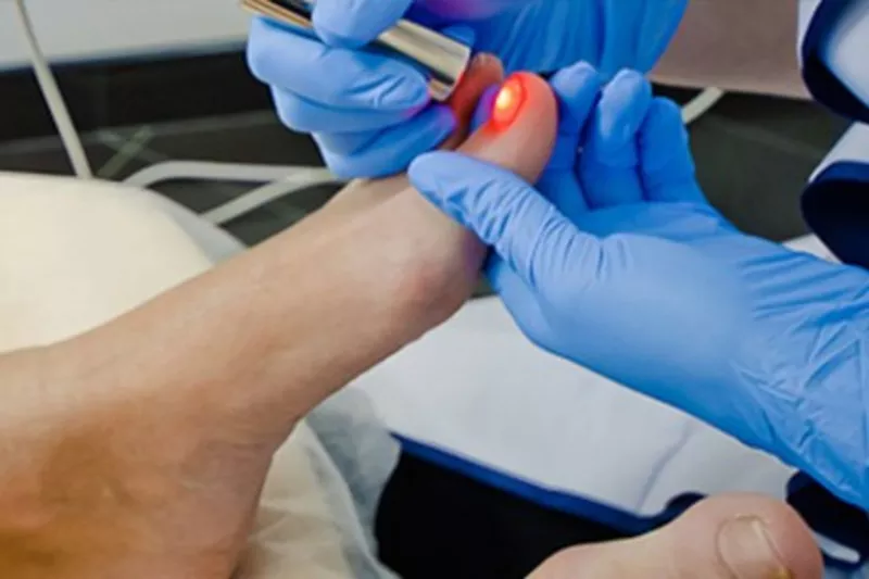Tratament laser a onicomicozei (Infectia fungica a unghiei,  micoza 