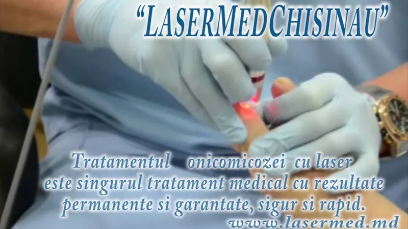 Tratament laser a onicomicozei (Infectia fungica a unghiei,  micoza  2