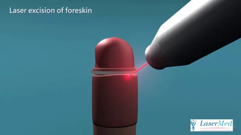 Circumcizia cu laser (ablatia laser a preputului) la bărbații in Moldo