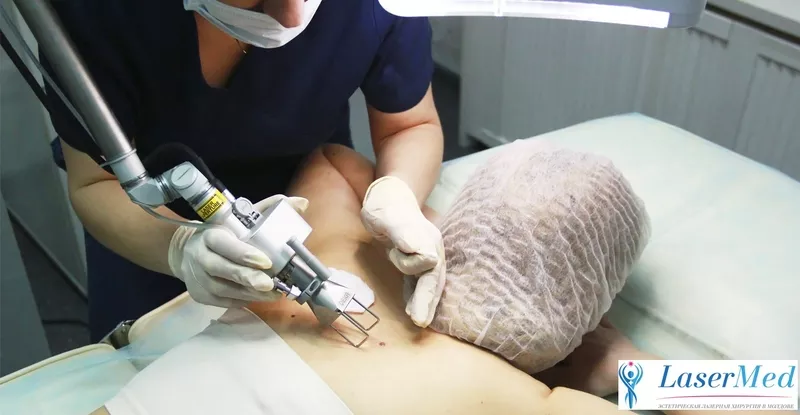 Indepărtarea (eliminarea,  inlaturarea) alunitelor (nevilor) cu laser  3