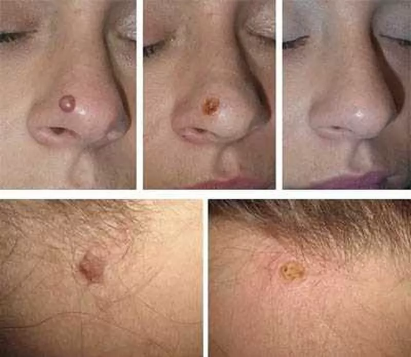 Indepărtarea (eliminarea,  inlaturarea) alunitelor (nevilor) cu laser  5