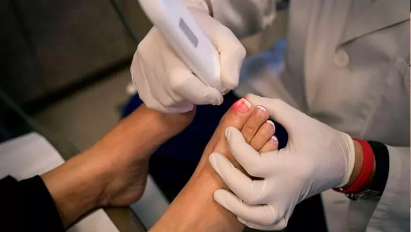   Corectie laser (Tratament laser) a unghiei incarnate in Chisinau