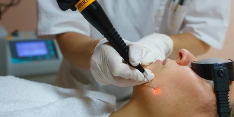 Indepărtarea (eliminarea,  inlaturarea) alunitelor (nevilor) cu laser  7