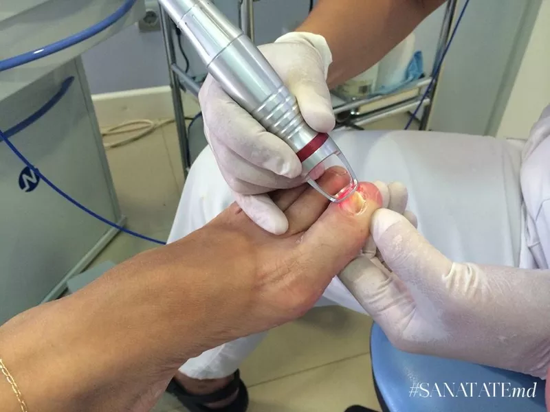 Лазерное лечение онихомикоза (грибок ногтей) в (Кишинев) Молдове! 2