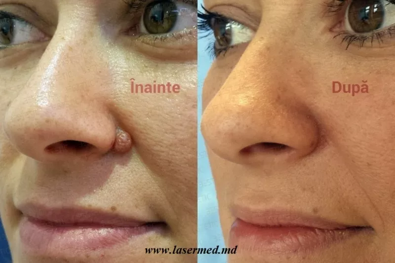 Лазерное удаление новообразований: родинок,  (невусов) бородавок папилл