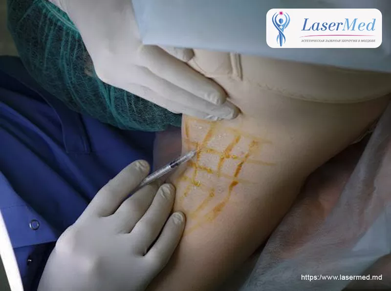 Tratamentul cu laser a  hiperhidrozei axilare in Moldova! 4
