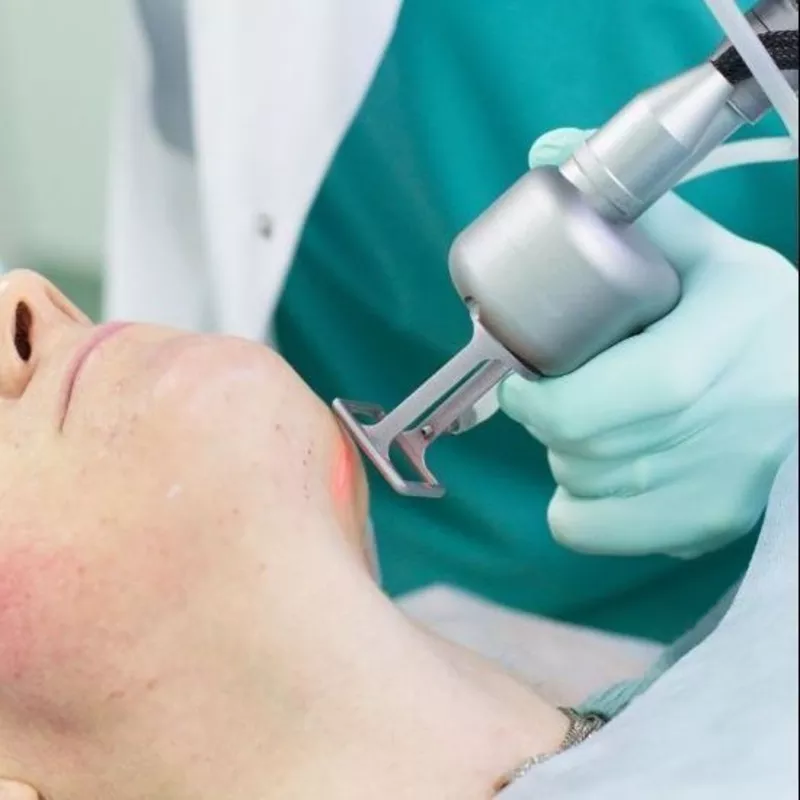 Лазерное удаление шрамов и рубцов (Лазерная коррекция дефектов кожи (рубцов/шрамов)) в Кишиневе,  Молдове! 2