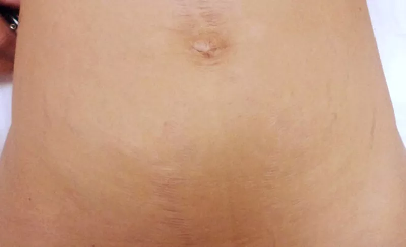 Лазерное удаление растяжек и стрий. Удаление растяжек лазером и стрий в Кишиневе!