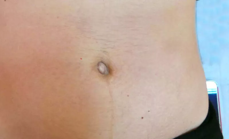 Tratamentul vergeturilor cu laser fractional in Moldova!