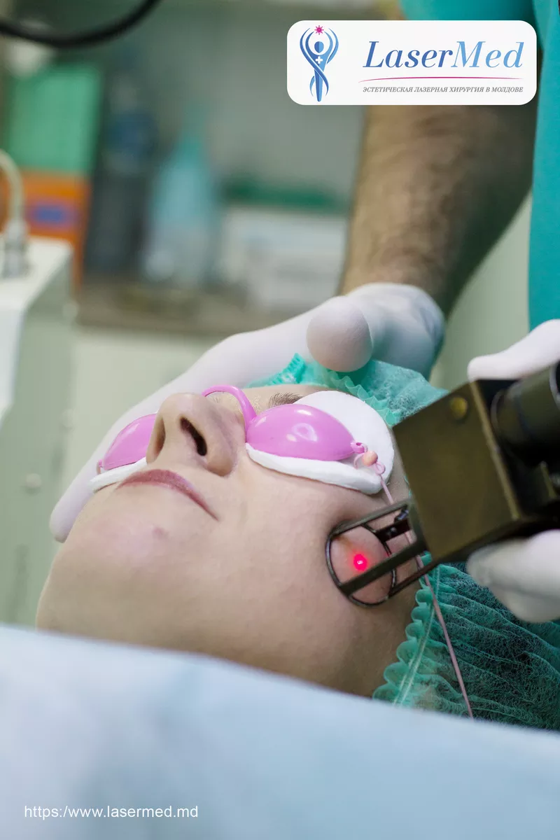  Tratamentele faciale cu laser CO2 fractional in combinatie cu terapia PRP in Moldova! 3