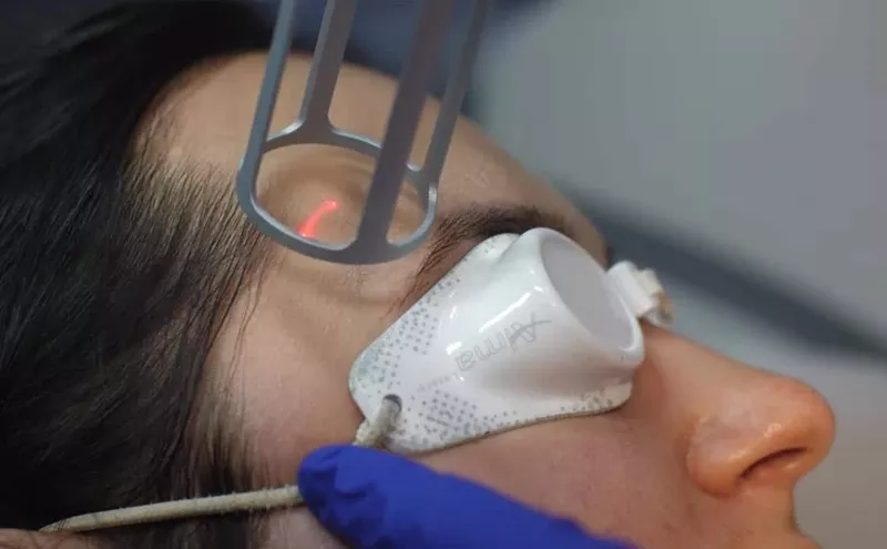 Rejuvenare cu laser a pleoapelor in Moldova (Chisinau)!