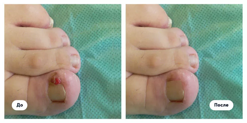   Corectie laser (Tratament laser) a unghiei incarnate in Chisinau,  Moldova!