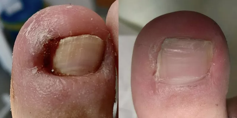   Corectie laser (Tratament laser) a unghiei incarnate in Chisinau,  Moldova! 2