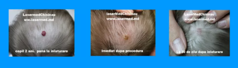 Tratamentul hemangioamelor cu Laser in Moldova