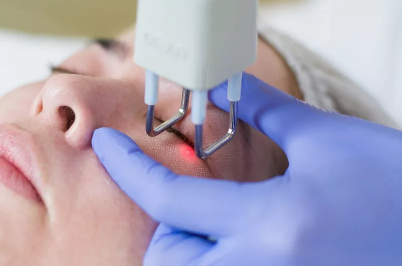 Blefaroplastie cu laser (Chirurgia laser estetica a pleoapelor) in (Ch