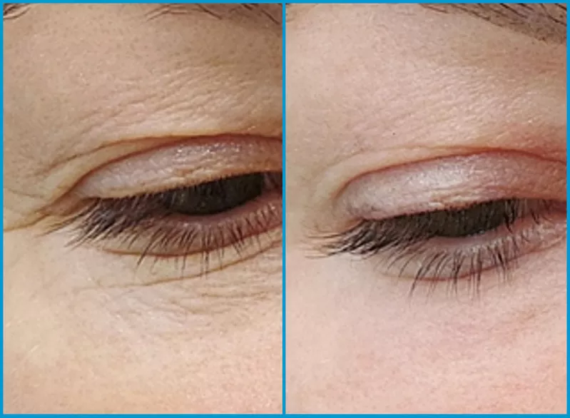 Blefaroplastie cu laser (Chirurgia laser estetica a pleoapelor) in (Ch 3