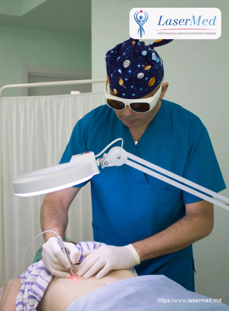 Tratamentul formatiunilor benigne cutanate cu laser in Moldova 6