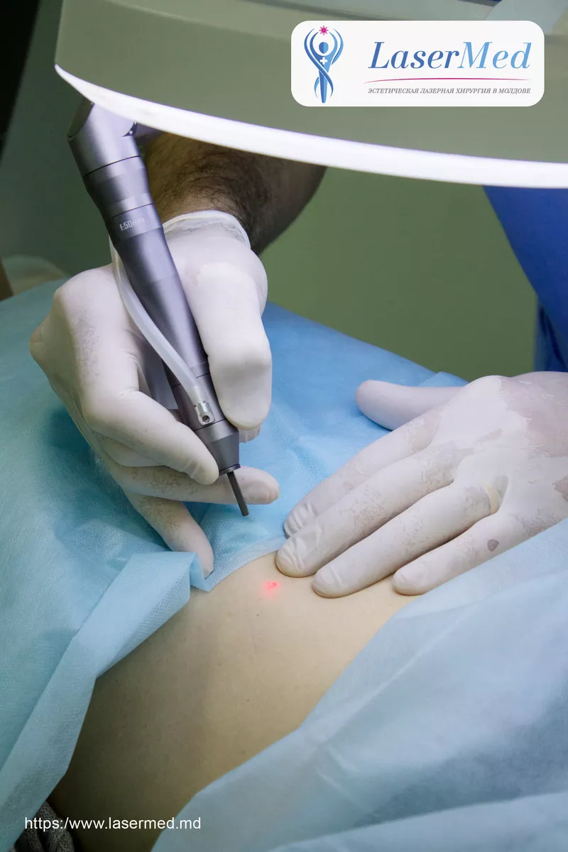 Tratamentul formatiunilor benigne cutanate cu laser in Moldova 10