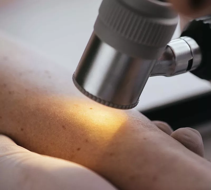 Tratamentul formatiunilor benigne cutanate cu laser in Moldova 4