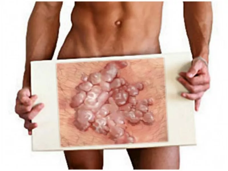 Лазерное удаление кондиломы и генитальных бородавок  в  (Кишинев) Молдове! 2