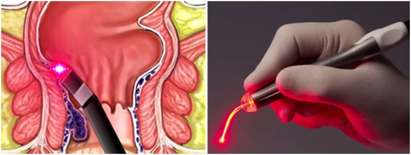 Лазерное удаление геморроя в Молдове, Кишиневе! 5