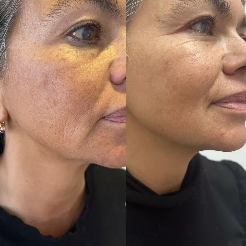     Подтяжка лица 