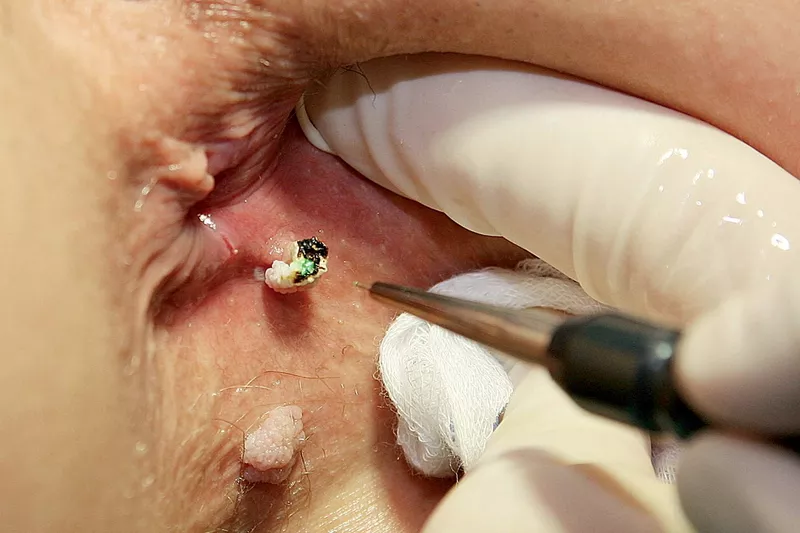 Tratament laser pentru vegetatiile veneriene (condiloamele, condyloma acuminata, negii genitali, condiloamele perianale, veruci genitale) in Chisinau, Moldova!