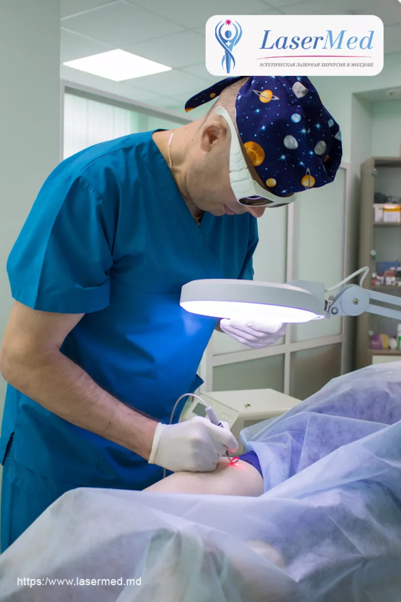 Лазерное лечение купероза,  телеангиоэктазий,  Лазерное удаление сосудов