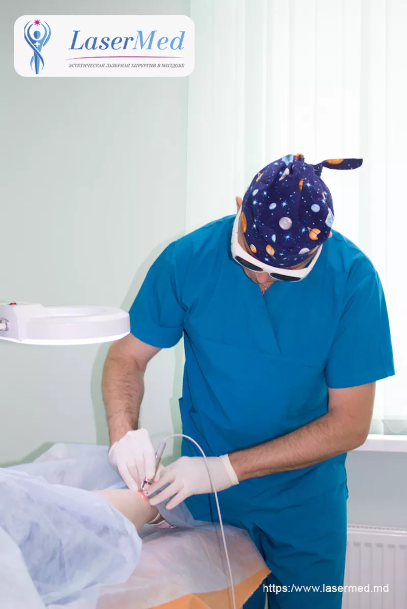 Лазерное лечение купероза,  телеангиоэктазий,  Лазерное удаление сосудов 2